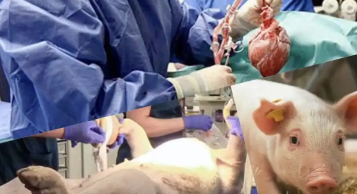 Second US pig to human transplant