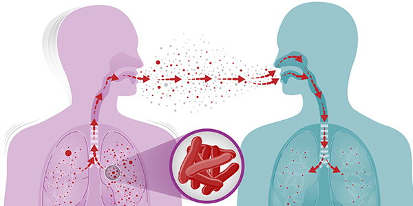 2024 World Tuberculosis Day: 5 warning signs you shouldn't ignore