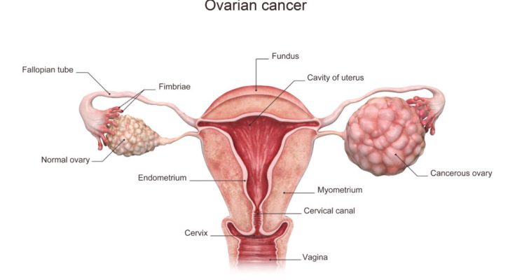 Seven essential tips to prevent ovarian cancer