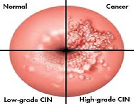 cervical cancer sex