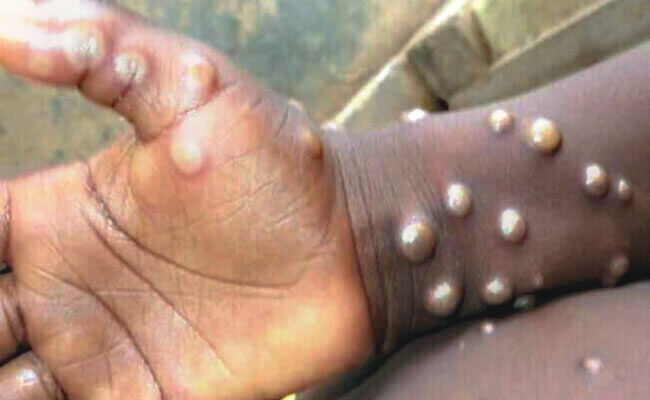 How deadly is monkeypox? - Tribune Online