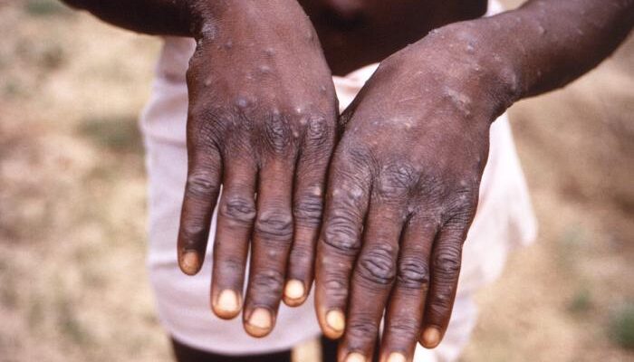 Nigeria Records 49 Monkeypox Cases