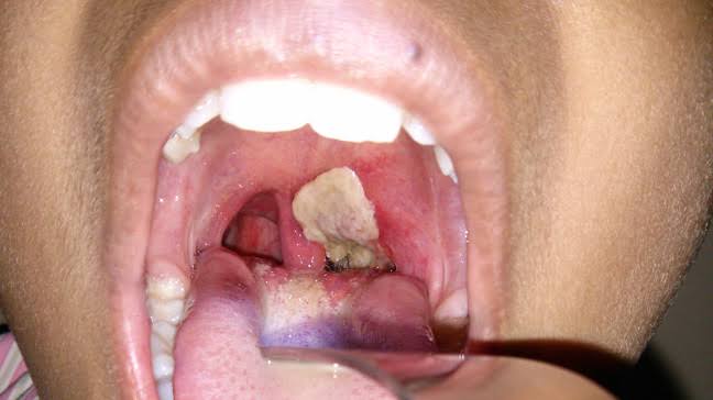 Diphtheria Infection: Causes, Symptoms, Prevention And Treatment
