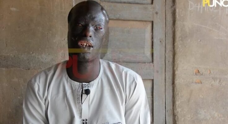 Man Narrates How His Cousin Bathed, Fed Him With Acid As A Baby (VIDEO)