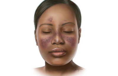 How women can manage various types of Lupus