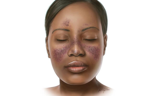 How women can manage various types of Lupus