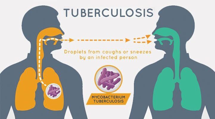 156,000 Nigerians Died Of Tuberculosis In 2020