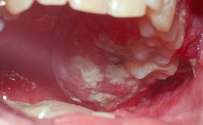 Mouth cancer is preventable — Don