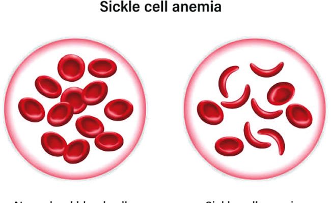 Facts about Sickle Cell Disease