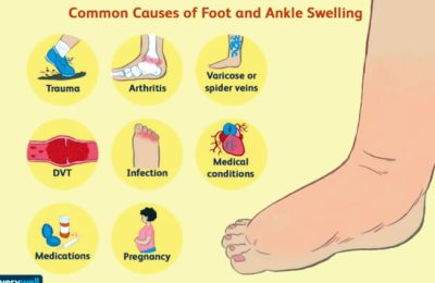 What is that swollen feet telling you?