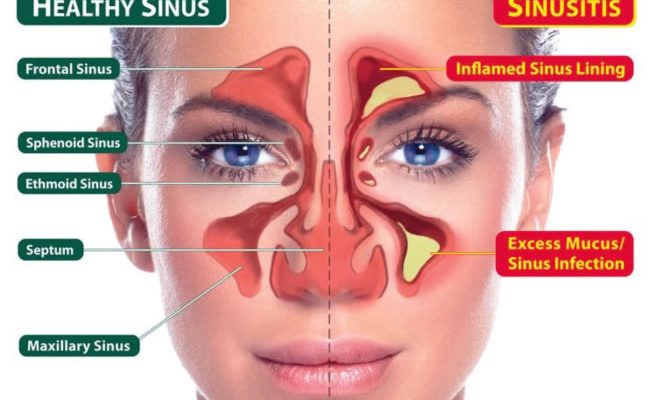 Dos and don’ts in managing sinusitis