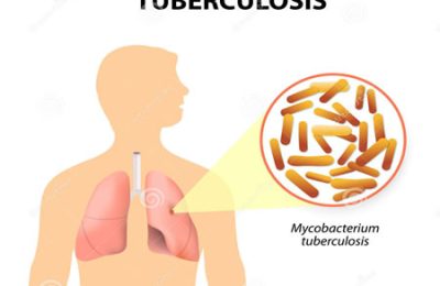 Is this tuberculosis?