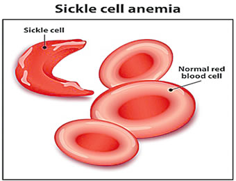 present newborn babies for sickle cell screening , sickle cell, Screening of newborns for sickle cell disease