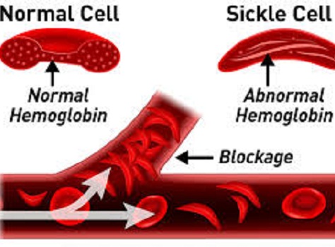 Initiative takes fight against sickle cell disease to