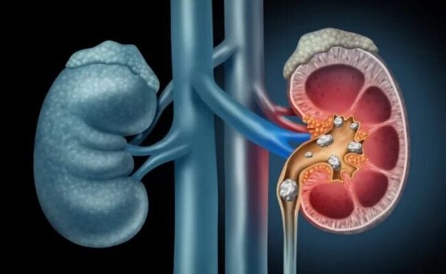 10 essential steps to prevent kidney damage