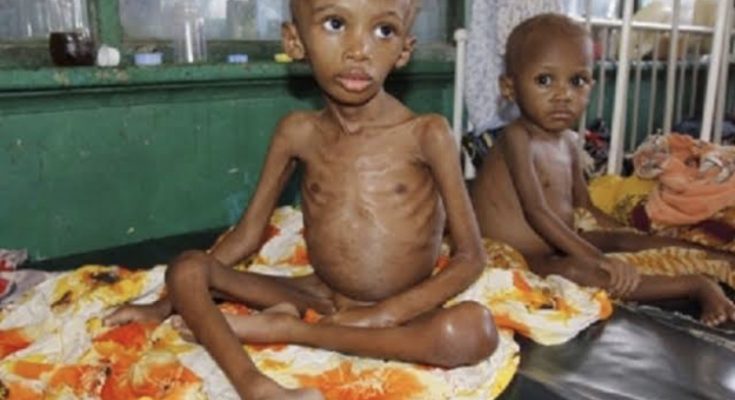 4m Children In Northeast, Northwest Are Malnourished