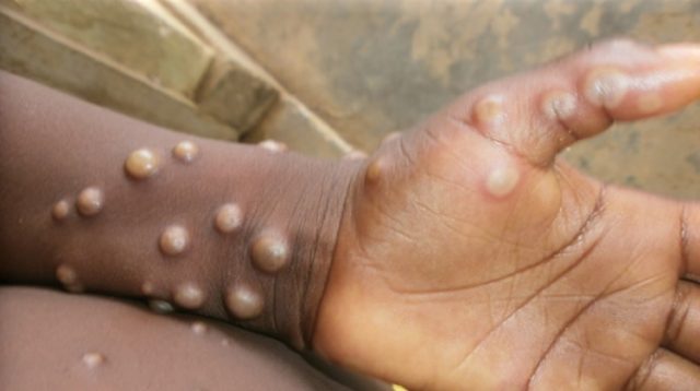 Symptoms of monkeypox