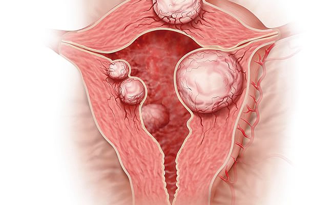 Natural ways to prevent fibroids, Fibroid