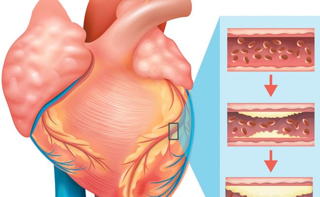 Babies born to women consuming high fat, sugary diet risk heart disease, diabetes as adults—Scientists