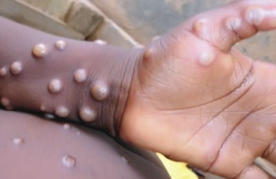 Two suspected monkeypox cases reported in Osun, How to prevent, syphilis could be monkeypox, 108 confirmed cases of Mpox recorded in Nigeria till date - Red Cross