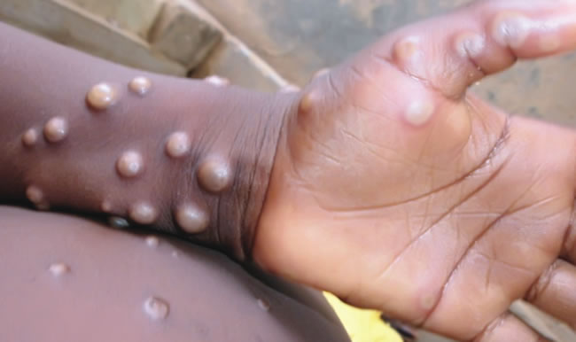 Two suspected monkeypox cases reported in Osun, How to prevent, syphilis could be monkeypox, 108 confirmed cases of Mpox recorded in Nigeria till date - Red Cross