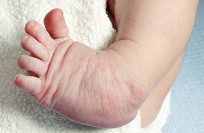 Clubfoot: With treatment, 95% can walk, run, and move for life