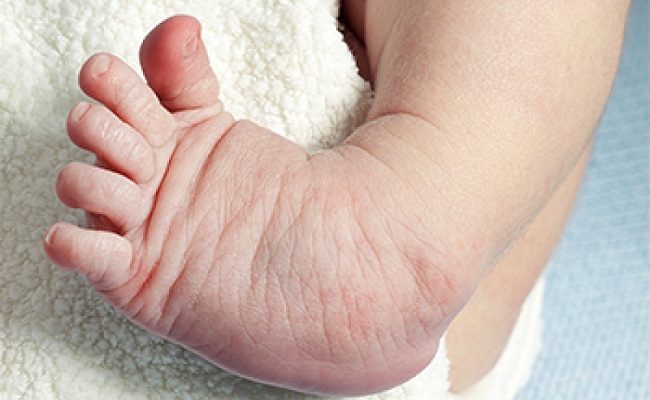 Clubfoot: With treatment, 95% can walk, run, and move for life